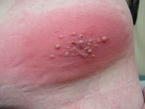 Red Itchy Bumps on Skin - Pictures, Causes, Treatment