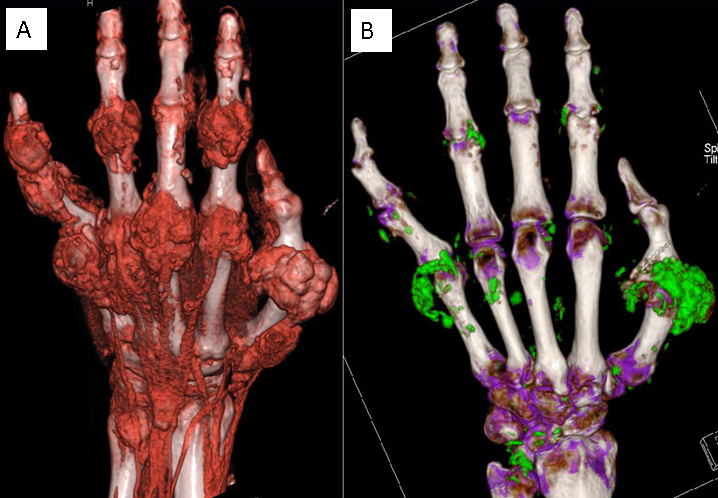 Dual-energy computed tomography (DECT) is a new diagnostic tool for gout