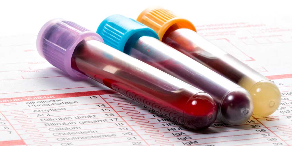 Systematic autoantigen analysis identifies a distinct subtype of scleroderma with coincident cancer