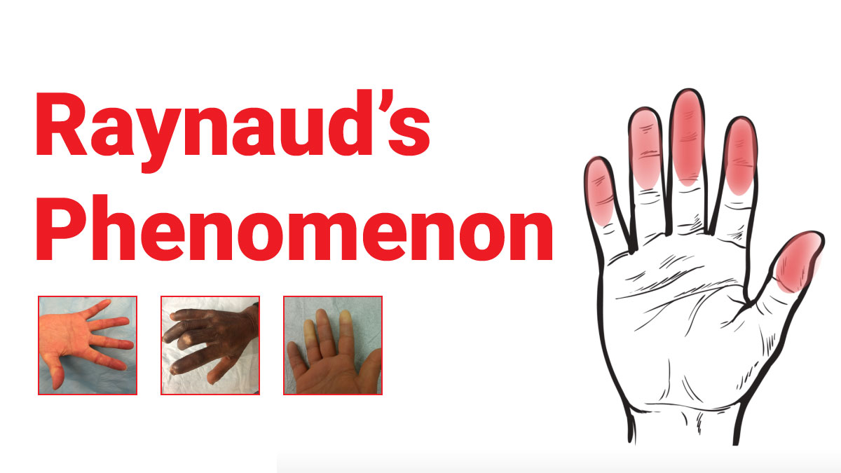 Raynaud’s Phenomenon : What You Should Know