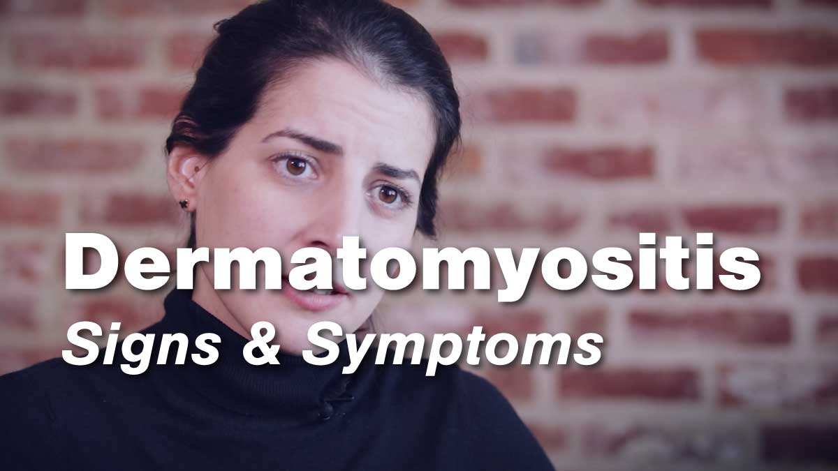 Dermatomyositis – Signs & Symptoms | Johns Hopkins