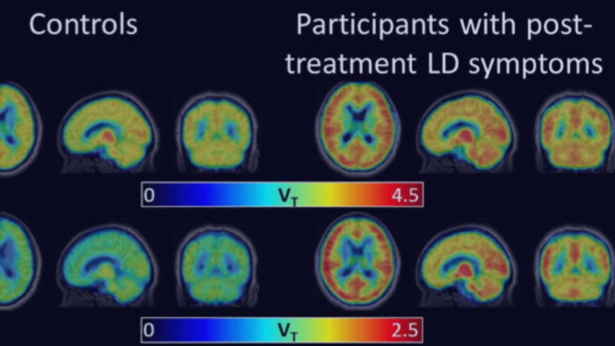 PET images show elevated cerebral glial activation in Lyme disease patients compared to controls